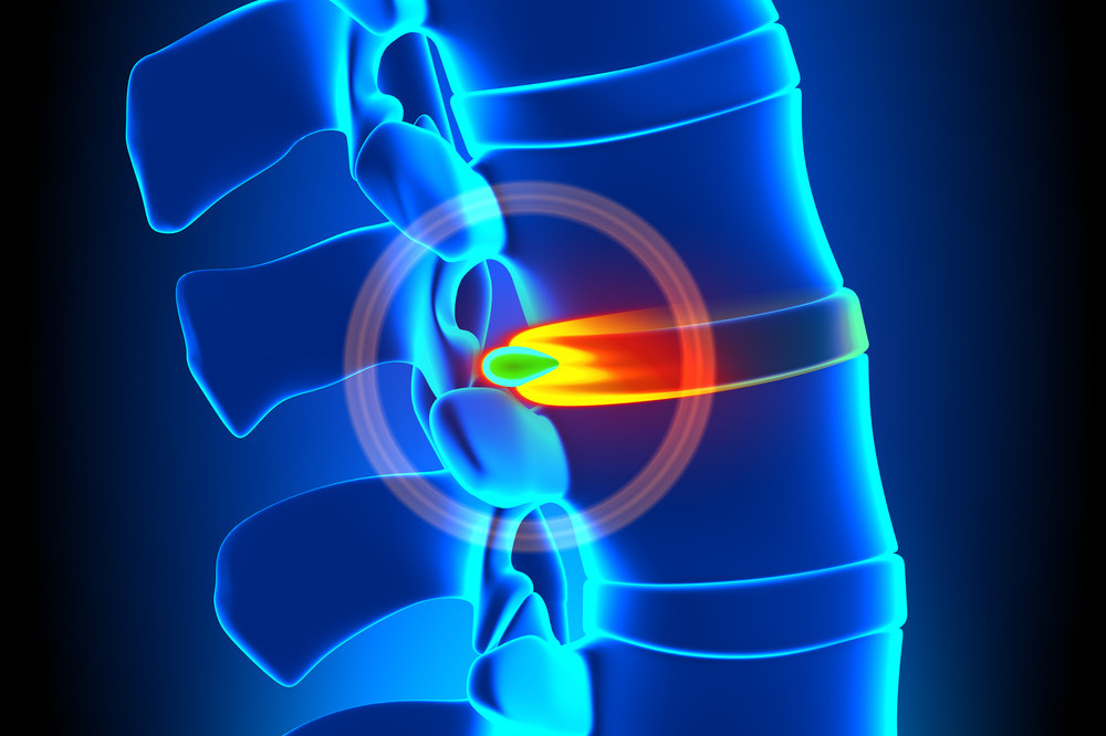 Herniated Disc